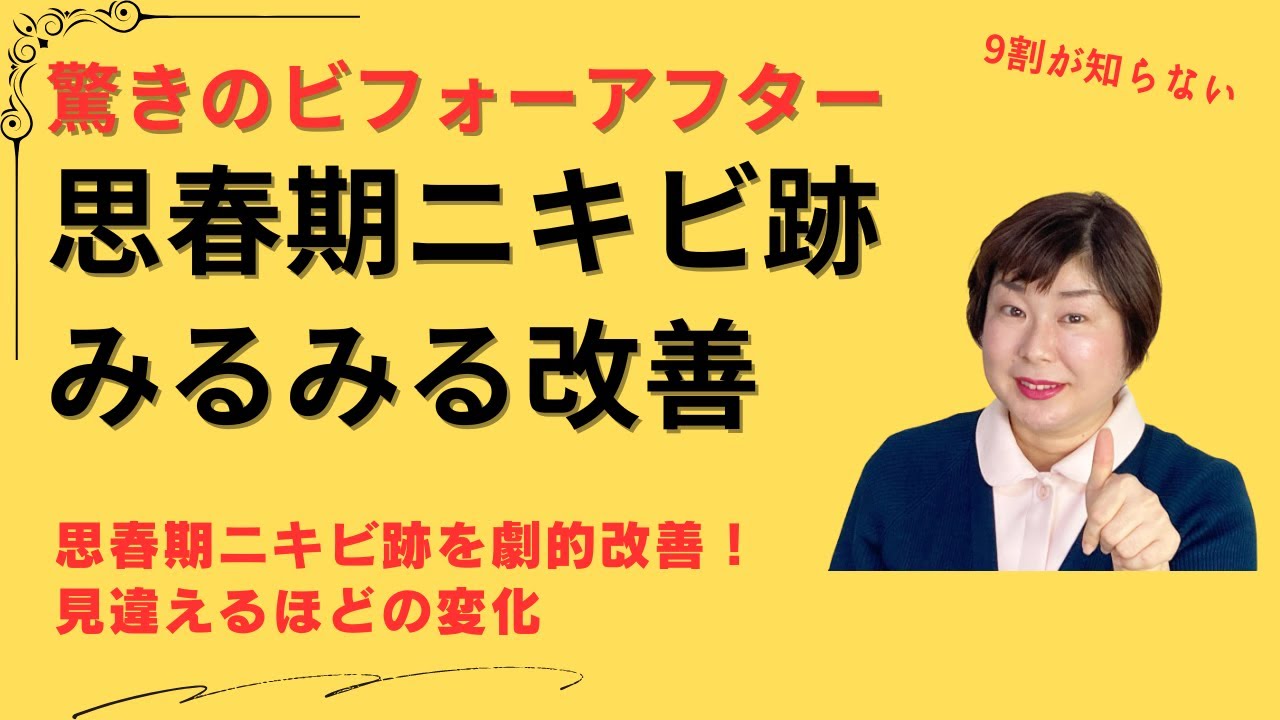 思春期ニキビ【全然治らなかったニキビ跡】みるみる改善